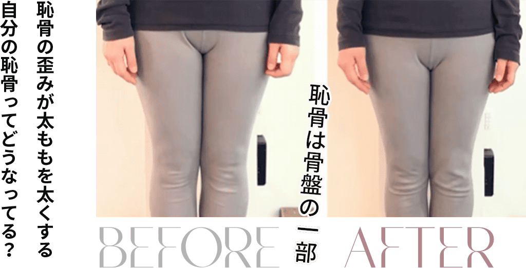 恥骨の歪みが太ももを太くする自分の恥骨ってどうなってる？
